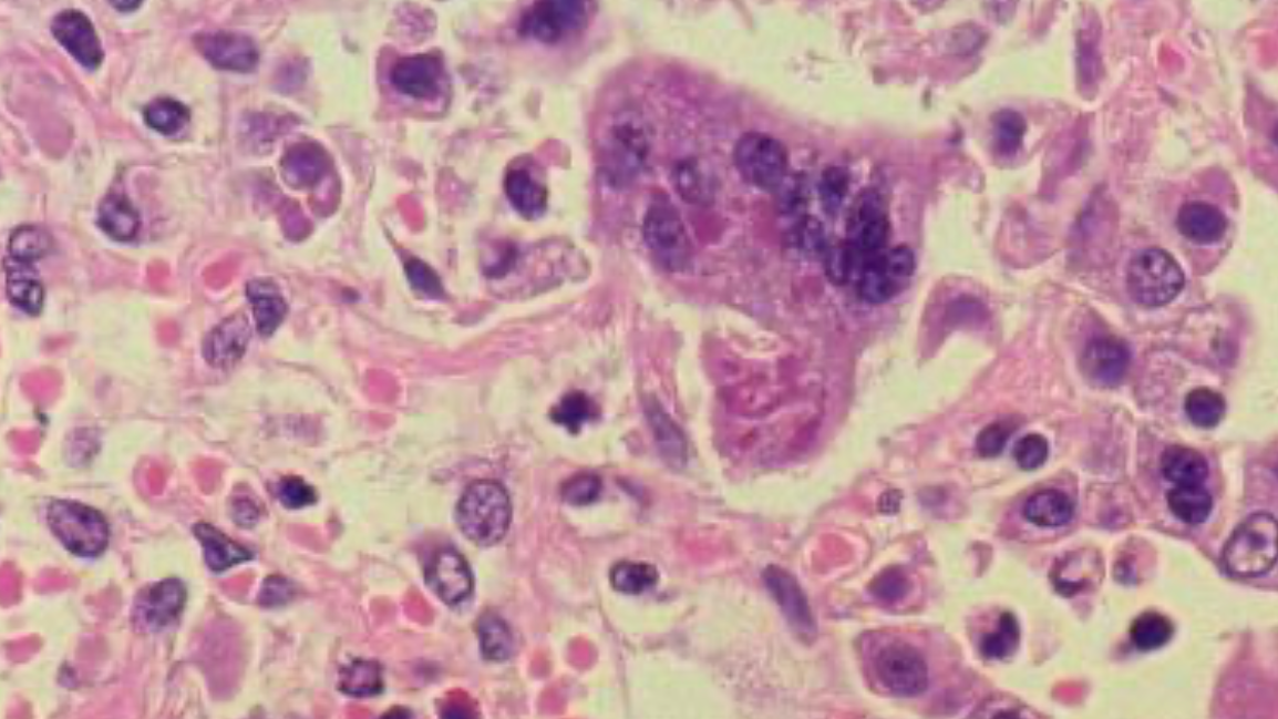 Wisconsin measles outbreak grows to nearly 40 confirmed cases