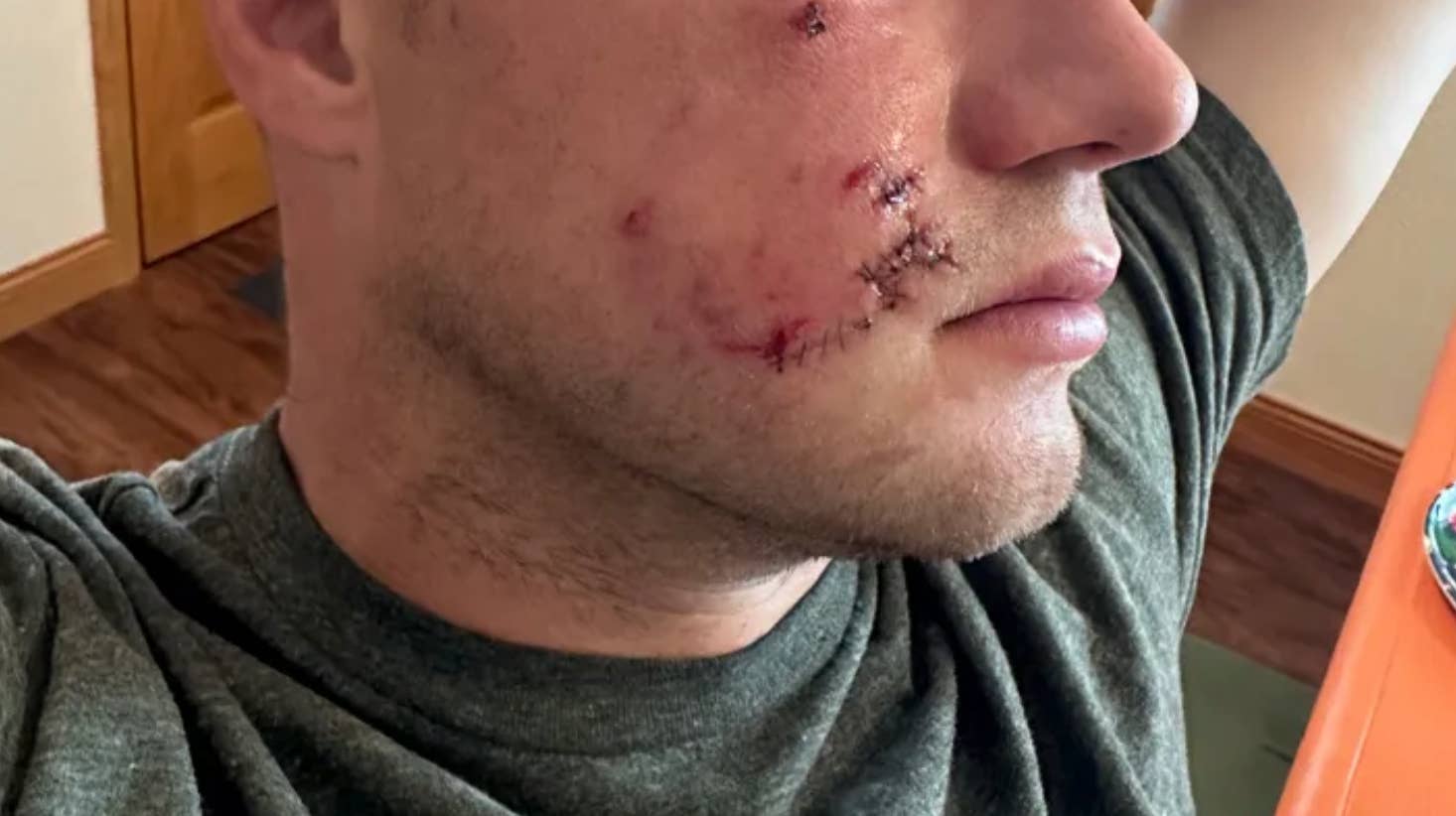 Moorhead man recovering after attack by neighbor's dog - Bring Me The News