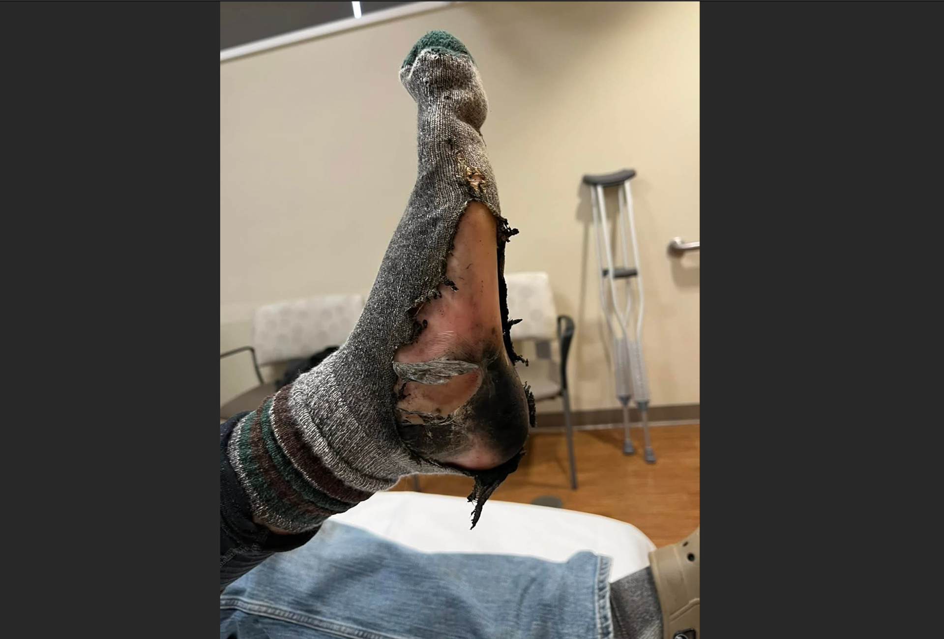 Foot Exploding Heated insoles explode, leave Minnesota man with severe burns - Bring ...