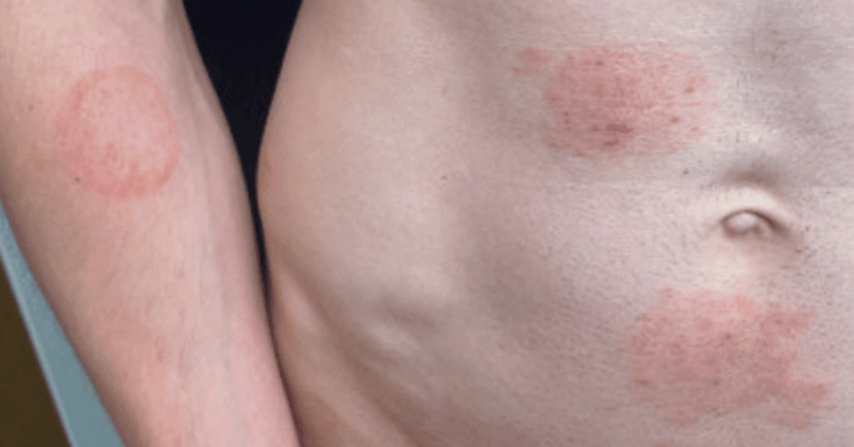 Twin Cities experiencing surge of sexually-transmitted ringworm cases - Bring Me The News