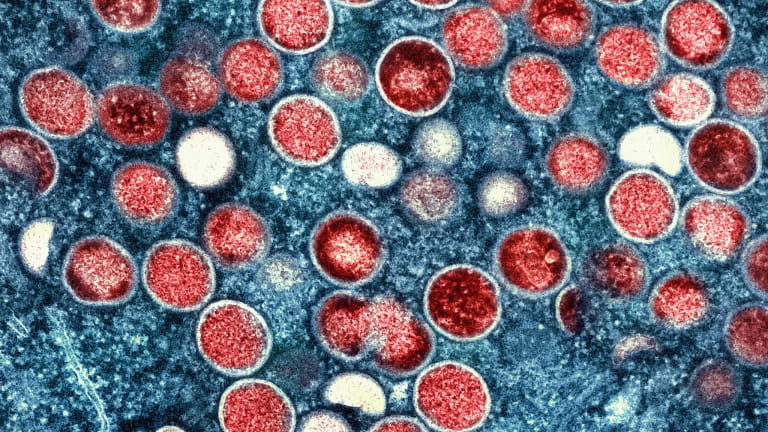Minnesota surpasses 100 confirmed cases of monkeypox