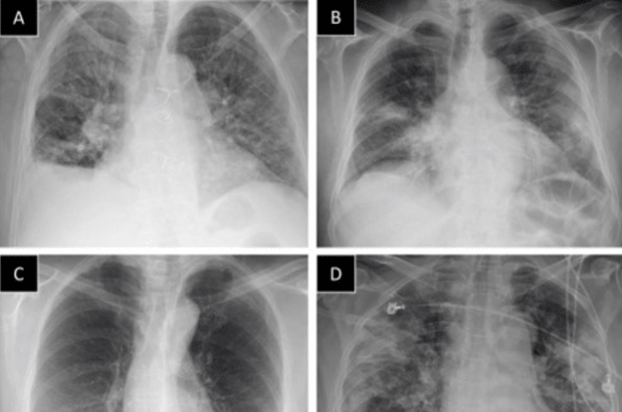 M Health Fairview implements chest X-rays to identify COVID-19 - Bring ...