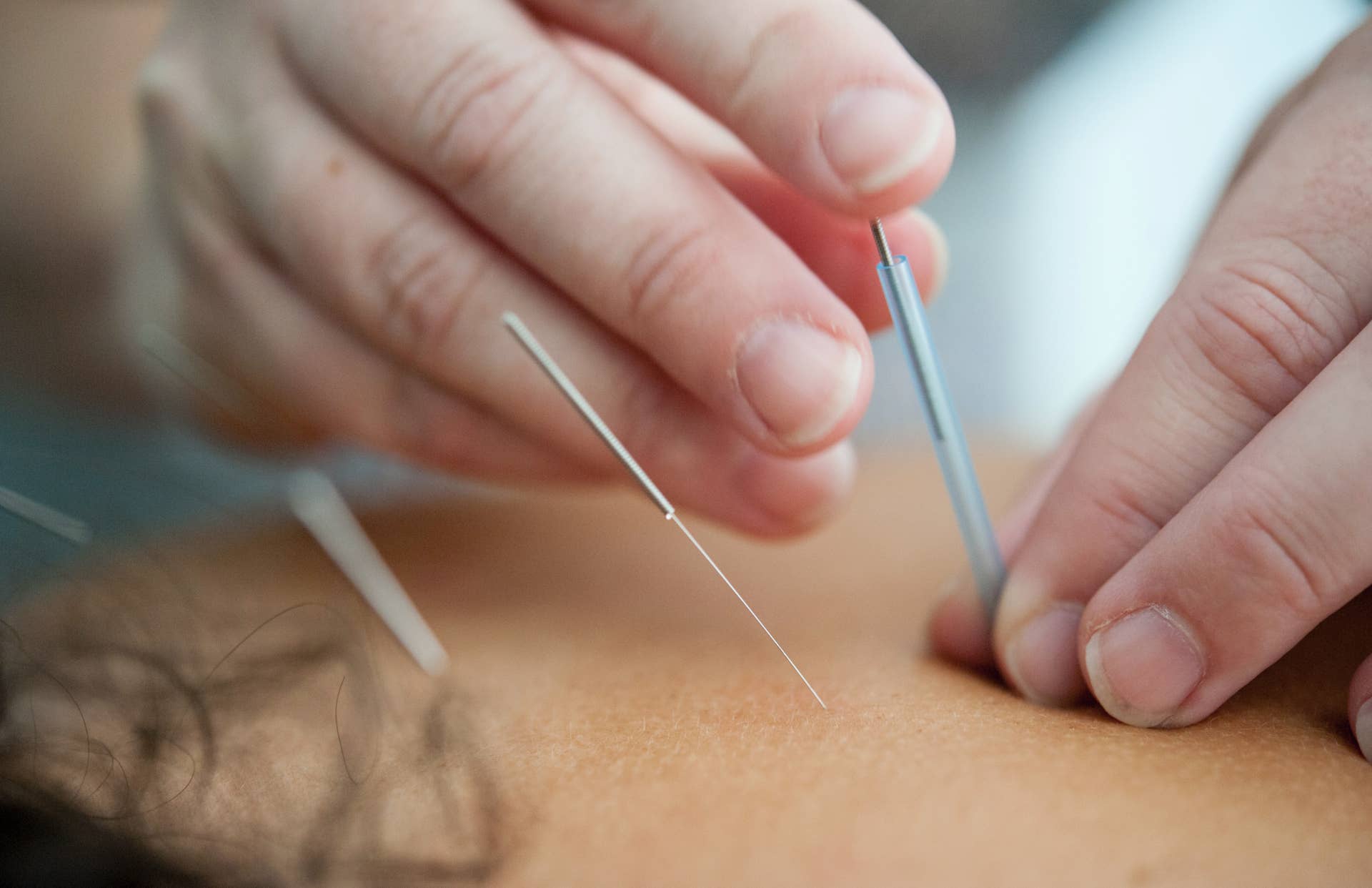 Charges: Twin Cities acupuncturist defrauded Medicaid out of $1.68M - Vimarsana News