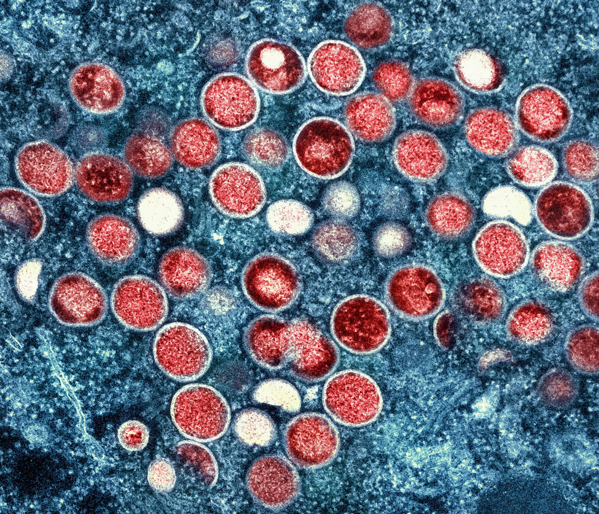 Minnesota up to 6 confirmed cases of monkeypox virus - Vimarsana News